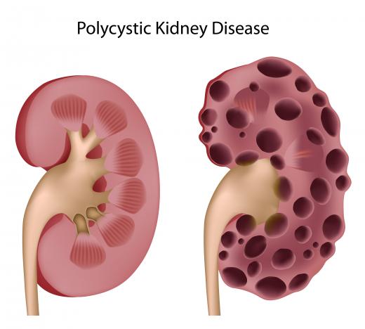 An example of a healthy kidney and one with polycystic kidney disease.