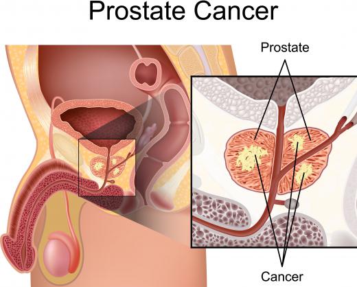 Certain herbal medicines have shown the ability to help fight prostate cancer.