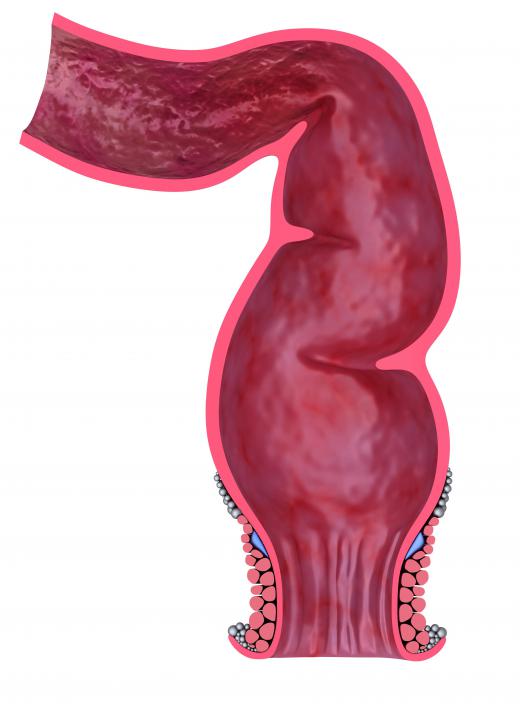 A hemorrhoid suppository is inserted directly into the rectum.