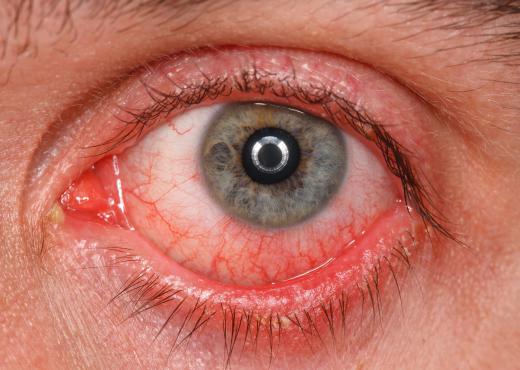 Seasonal allergies may cause pink eye.