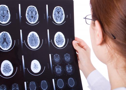 A neurologist will study the brain scans of someone with opsocionus symptoms to check for brain damage or tumors.