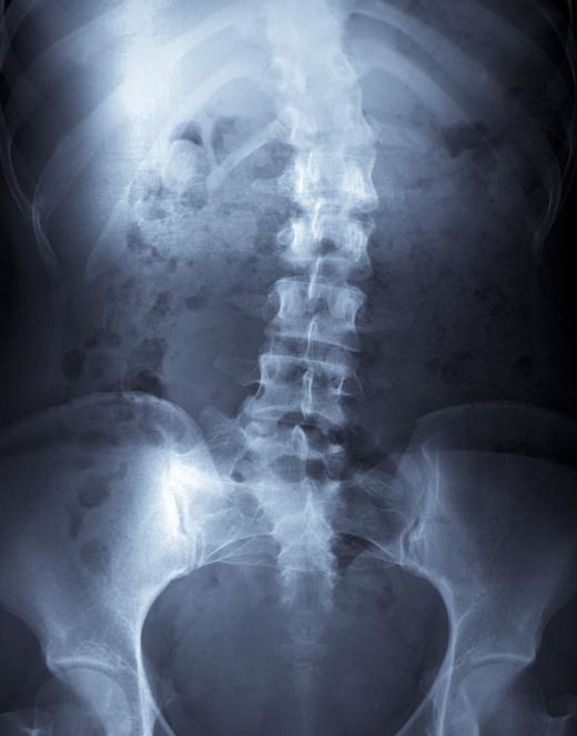 Scoliosis can be a symptom of Cat Eye Syndrome.