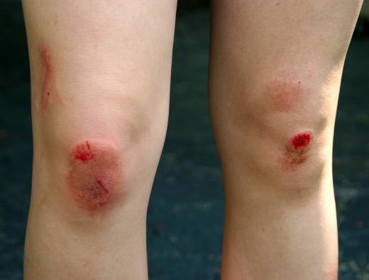 If someone with a bleeding disorder suffers a cut or abrasion, a coagulator may be necessary.