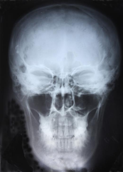 The maxillary sinuses are located just above the upper teeth.