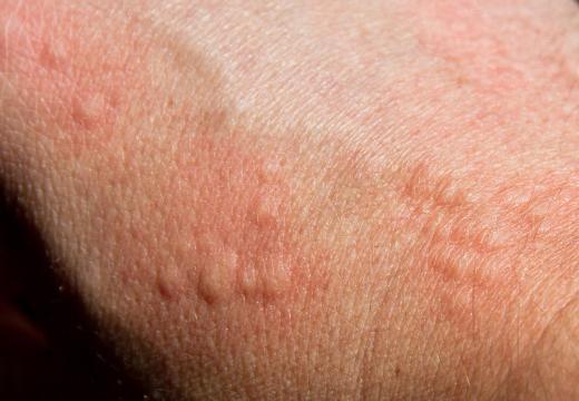 A latex allergy may cause skin hives.