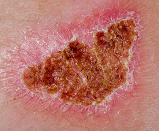 Treating a diabetic wound involves remove all of the dead skin and rinsing the wound with a saline solution.