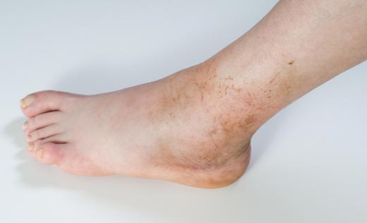 Problems with the lymph vessels may cause the ankles to swell.