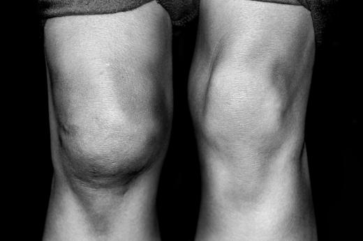 A person with a swollen knee.