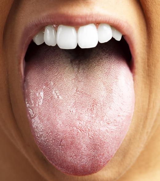 The tongue should be included in good dental health habits.