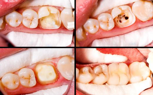 Fillings, crowns and root canals are among treatments for cavities.