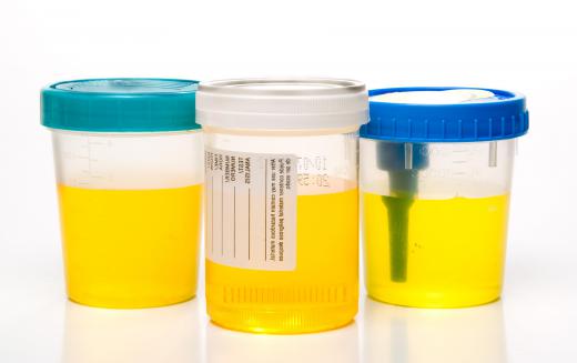 Urine samples will be collected from a patient if they are suspected of having lymphoma.