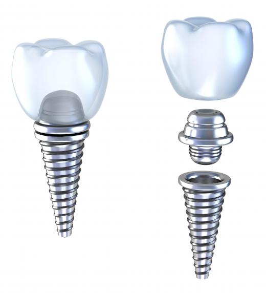 An illustration of the parts of a dental implant, which may be used to replace a missing tooth.