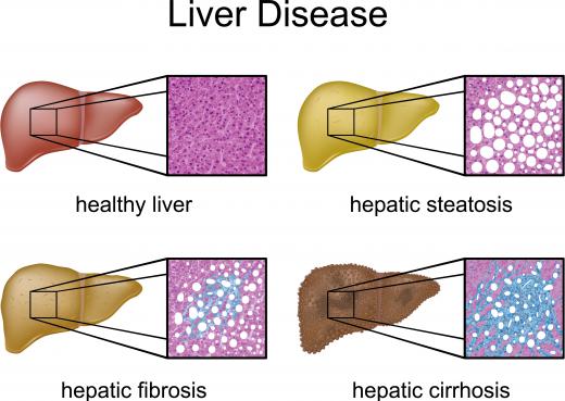 Types of liver disease, including cirrhosis, a complication of hepatitis.