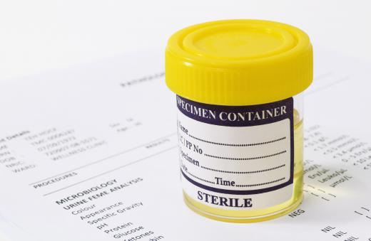 A urinalysis is typically used to help diagnose the cause of hematuria.