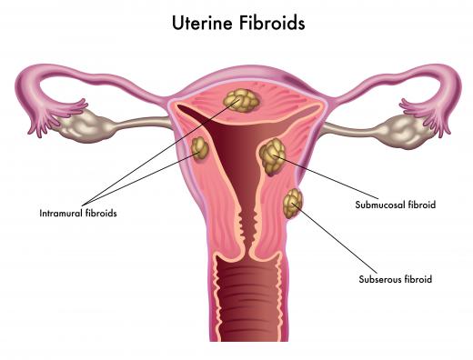 Women who have uterine fibroids may be unable to use Activella.