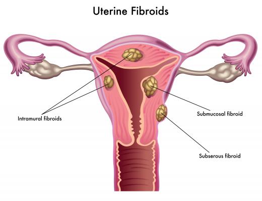 Fibroids can be found in the muscular wall of the female uterus.