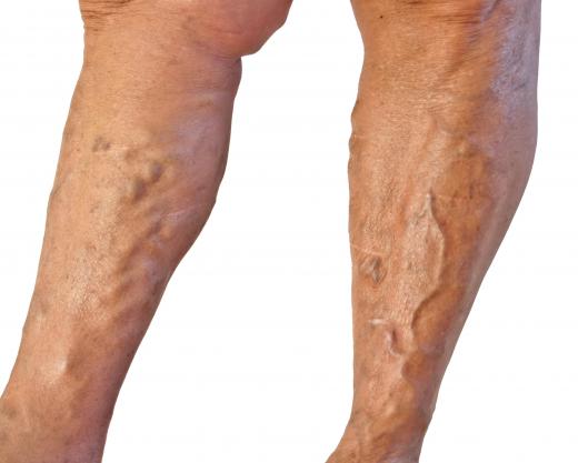 Lichen aureus may develop above a varicose vein.