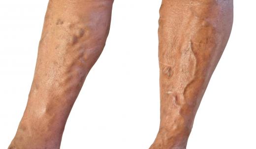 Varicose veins can cause swollen feet.