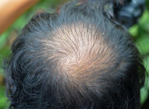 A man with male pattern baldness may choose to employ the comb over technique.