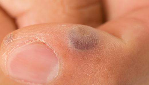 Freezing warts with liquid nitrogen often causes blisters to form where the treatment was performed.