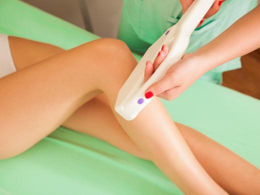 Laser treatment may be performed to eliminate spider veins.