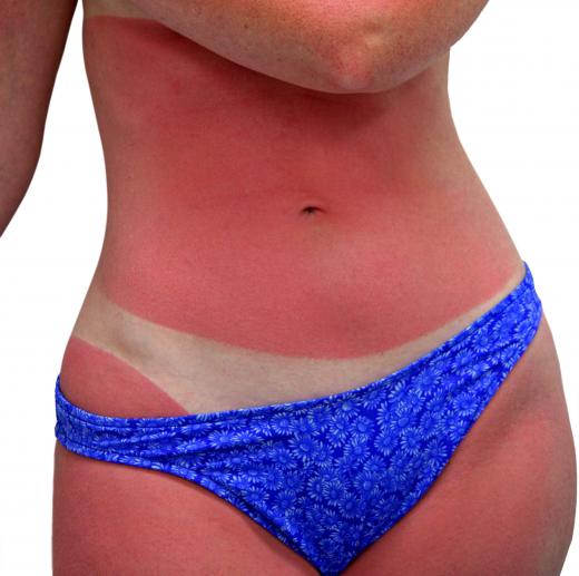 A sunburn can introduce the bacteria to the skin that causes bullous impetigo.