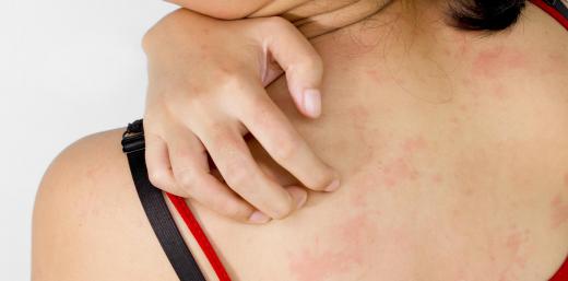 Apply an anti-itch cream to skin rashes to relieve symptoms.