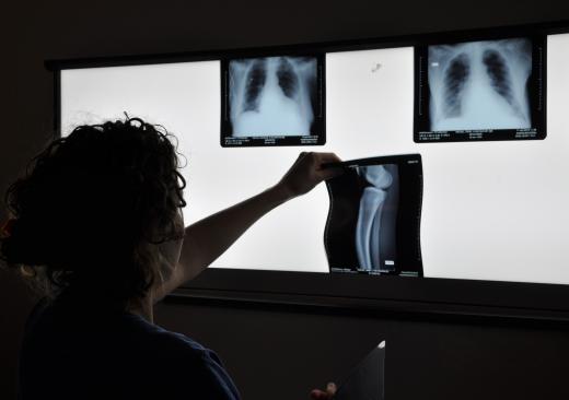 No evidence exists that a patient will have sustained damage from exposure to secondary radiation, such as from X-rays.