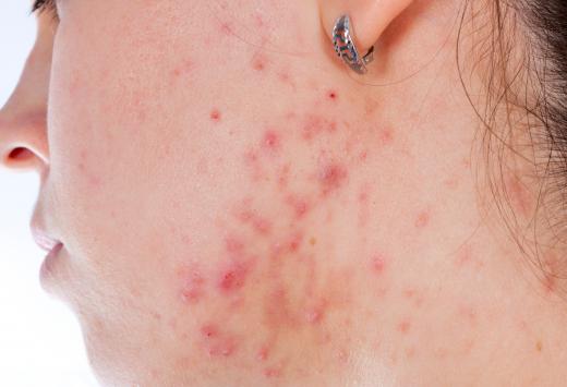 A person with severe acne should consult a dermatologist.