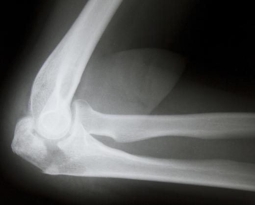 An X-ray will be used to determine the extent of a coronoid fracture.