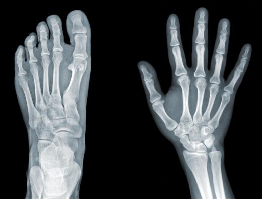 The extensor carpi radialist brevis attaches to the bone beneath the middle finger.