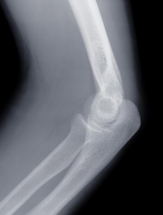 X-rays might be used in a procedure on the knee known as quadriceps-sparing.