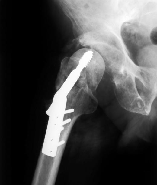 Titanium including nickel titanium may be used to reconstruct bones or joints after a fracture or other injury.