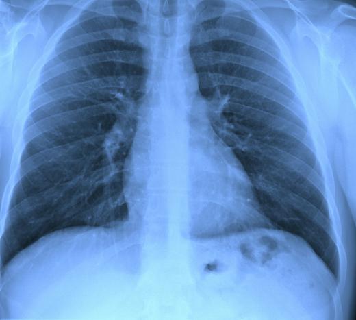 A chest x-ray is often used to diagnose miliary tuberculosis.