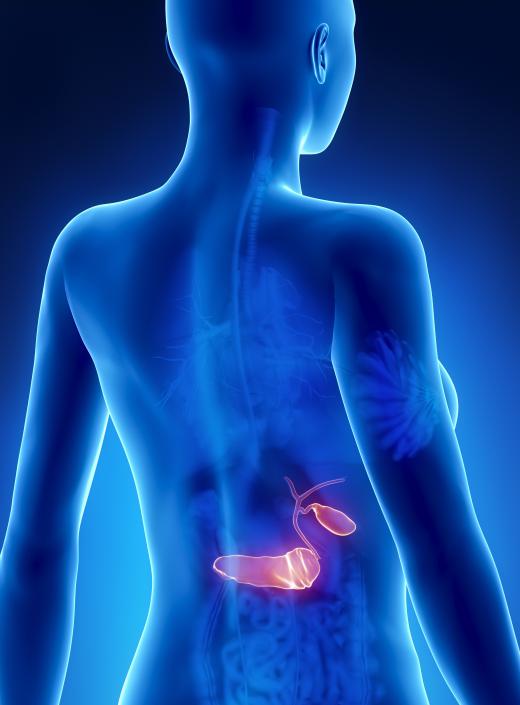 Gallstone pancreatitis occurs when a gallstone obstructs the gallbladder and causes the pancreas gland to become inflamed.