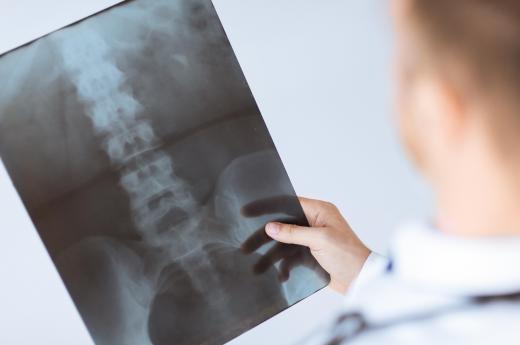 The presence of vertebral subluxations is confirmed with the help from an X-ray of the spinal column.