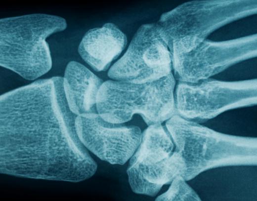 X-rays might be needed to rule out serious injuries of the wrist.