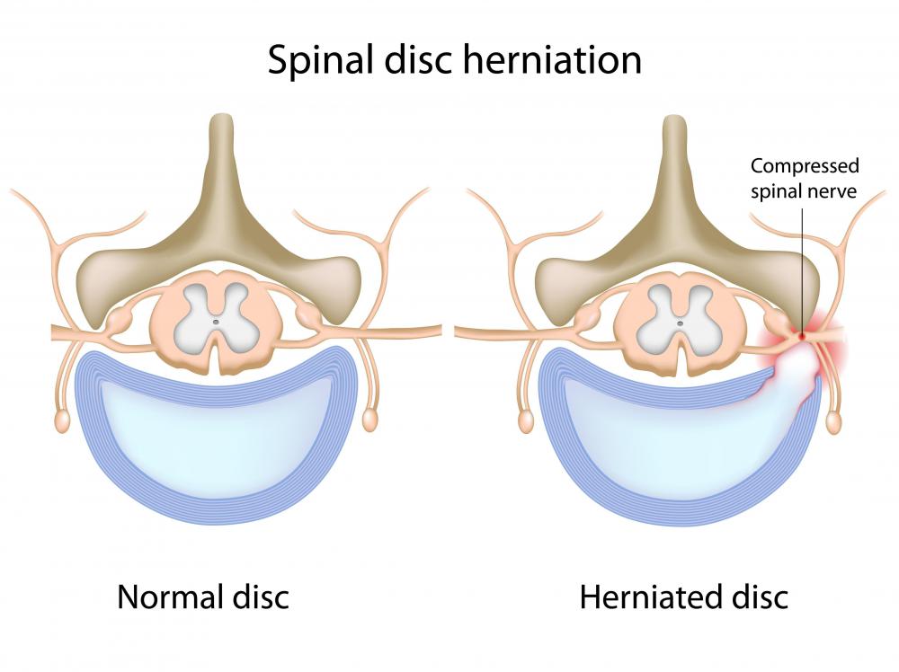 A healthy spine and a spine with a herniated disc, or disc protrusion.