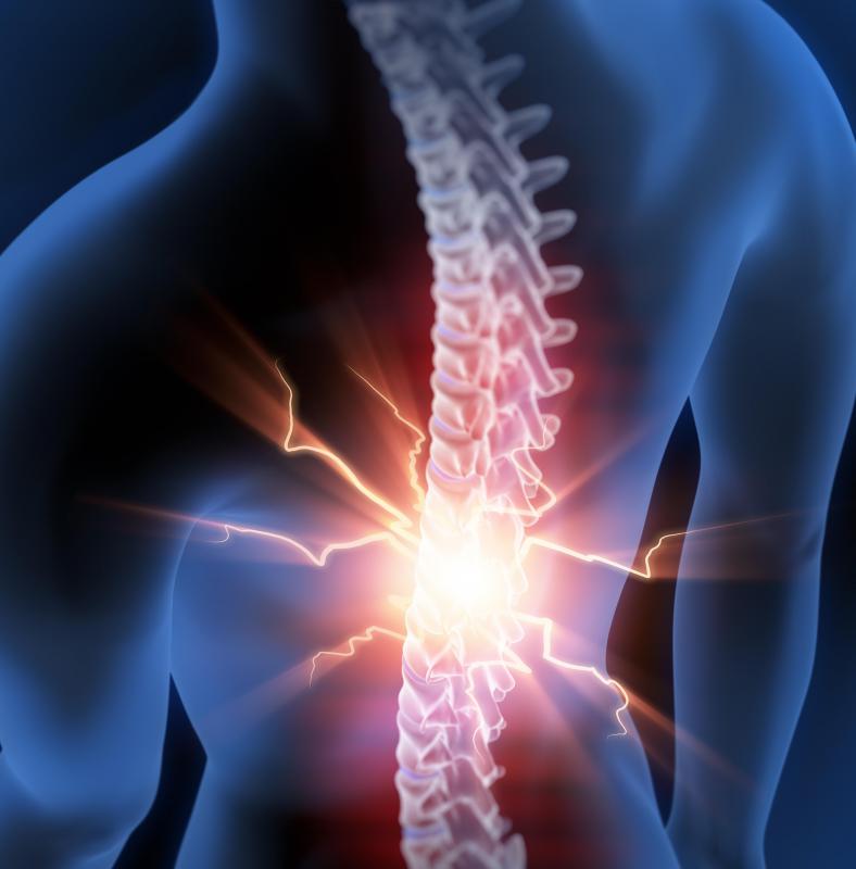 Anterolisthesis cervical spine image