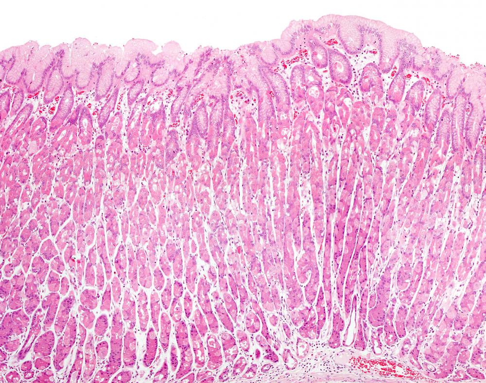 A inflamação das células do revestimento do estômago pode causar fezes melênicas.