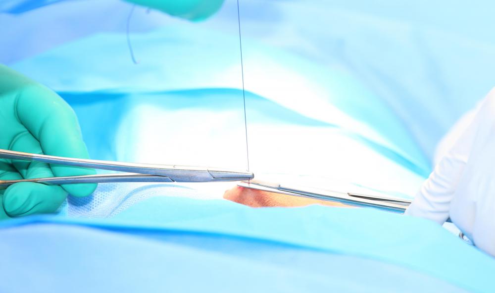 What Is a Suture Lift? (with pictures)