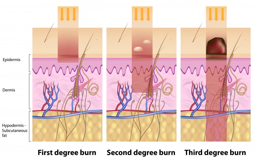 4th degree burn diagram