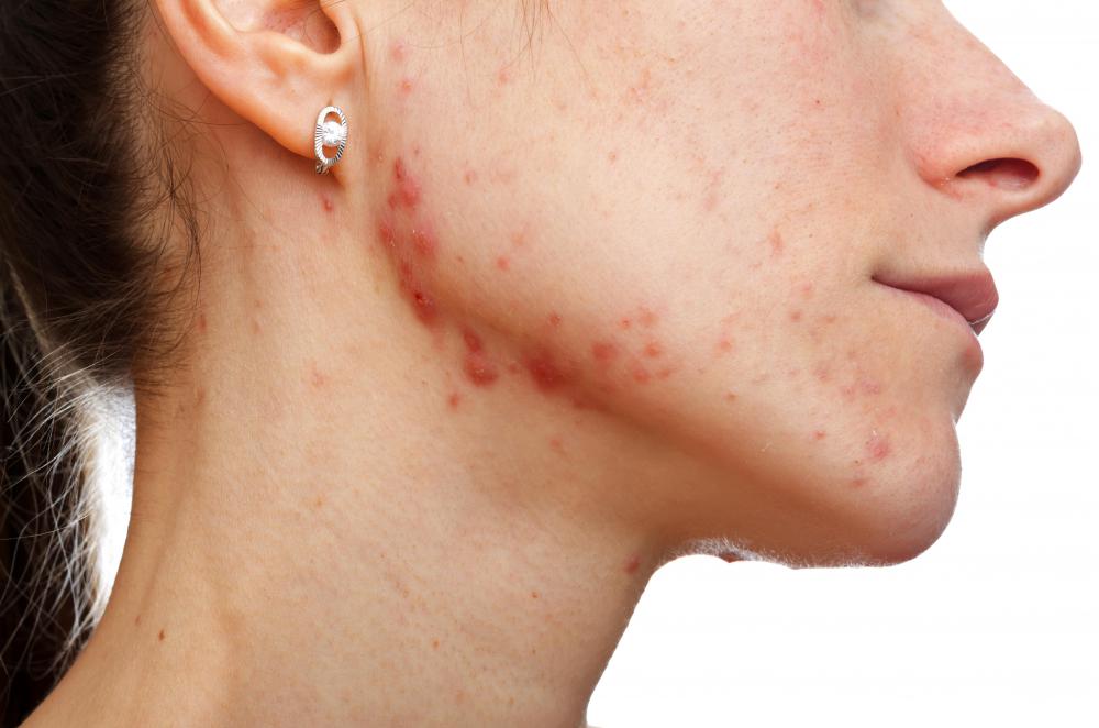 what-is-the-connection-between-estrogen-and-acne