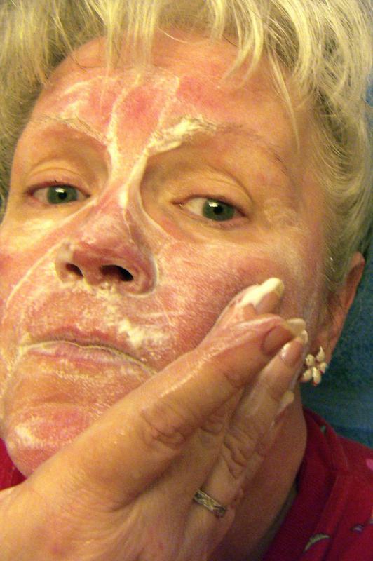 What are the Best Vitamins for Rosacea? (with pictures)