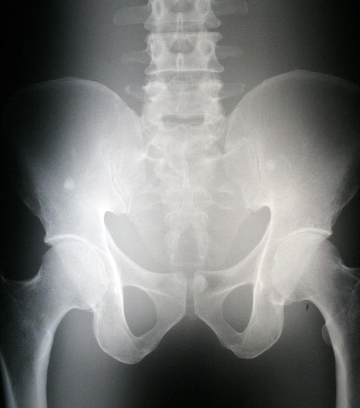 normal hip xray description